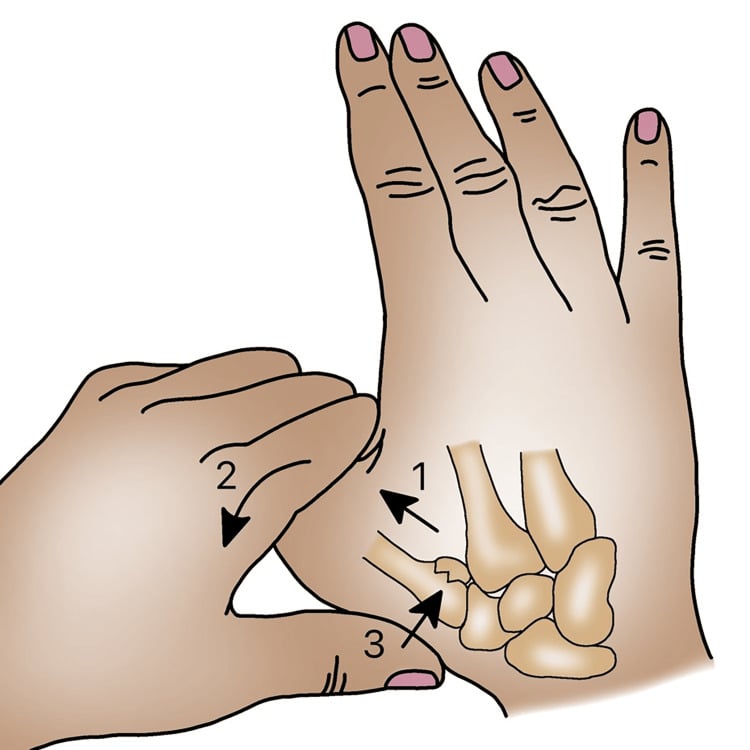 Diagram of the closed reduction manoeuvre for a Bennett fracture, with numbered arrows 1 to 3