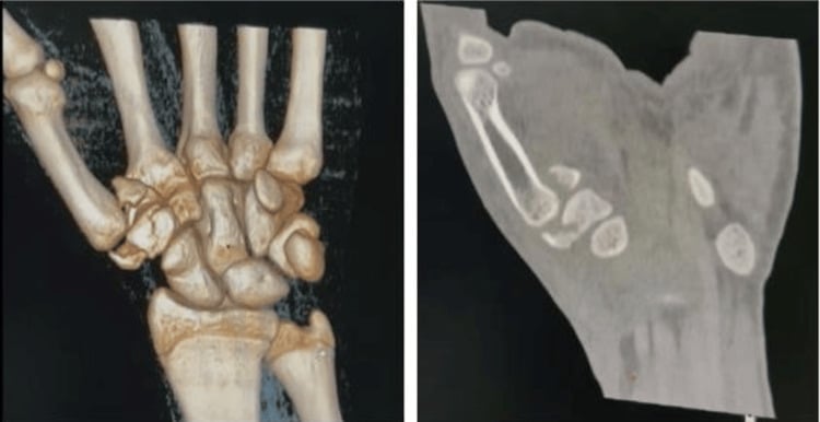 Three-dimensional CT reconstruction and a CT slice showing a Bennett fracture with an associated vertical trapezium fracture