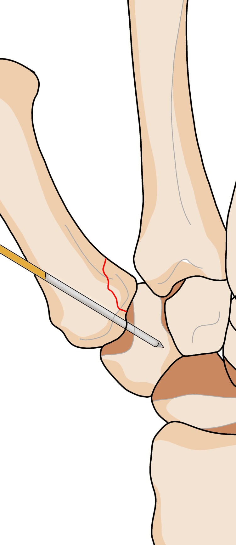 Diagram showing a K-wire directed from the first metacarpal base into the trapezium