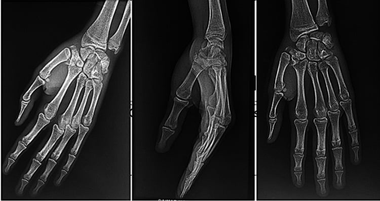Three radiographic views of the hand showing a Bennett fracture-dislocation with an associated trapezium fracture