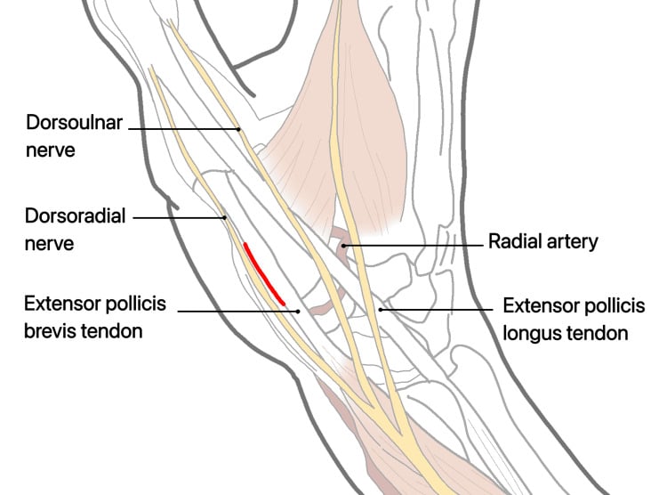 Diagram marking a dorsal thumb-base incision between the dorsoulnar and dorsoradial nerves, with the radial artery and EPB and EPL tendons labelled