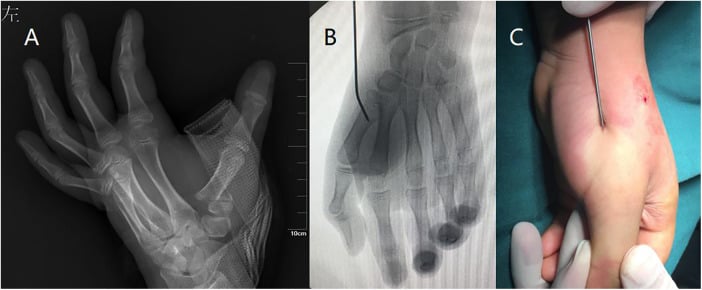 Paediatric thumb metacarpal base fracture on radiograph (A), on fluoroscopy with a percutaneous wire (B) and clinically with the wire in place (C)