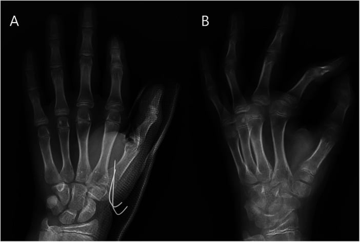 Paediatric thumb metacarpal base fracture held with two K-wires (A) and at follow-up after wire removal (B)