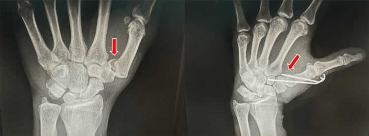 Radiographs before and after percutaneous K-wire fixation of a Bennett fracture, red arrows marking the fracture