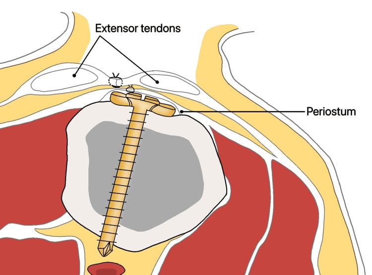 Cross-sectional diagram showing periosteal coverage between an implant and the extensor tendons