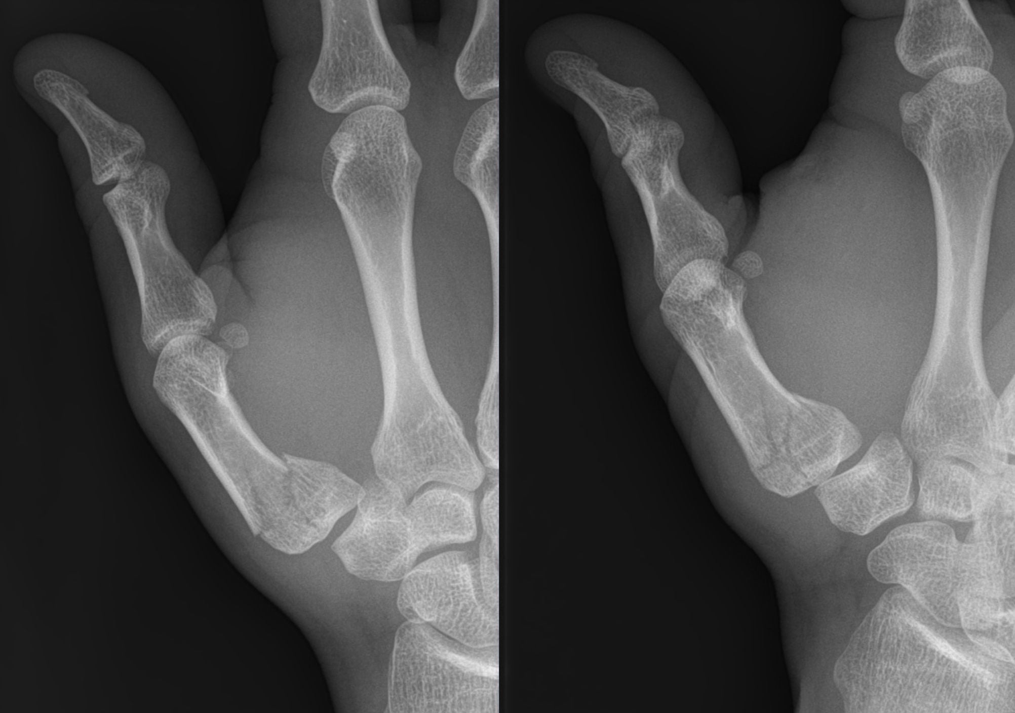 Two-view (oblique and lateral) radiograph of a comminuted intra-articular fracture of the base of the first metacarpal, a Rolando fracture.