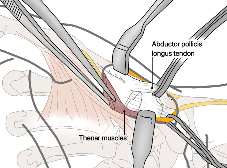 Operative diagram showing reflection of the thenar muscles beside the abductor pollicis longus tendon