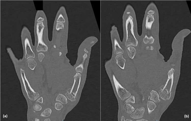 Coronal CT images showing a comminuted intra-articular first metacarpal base fracture and carpometacarpal subluxation