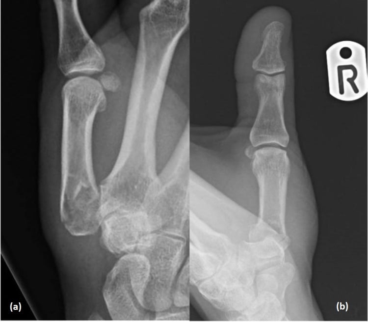 Two radiographs, (a) and (b), showing a first metacarpal base fracture with poorly defined trapeziometacarpal anatomy
