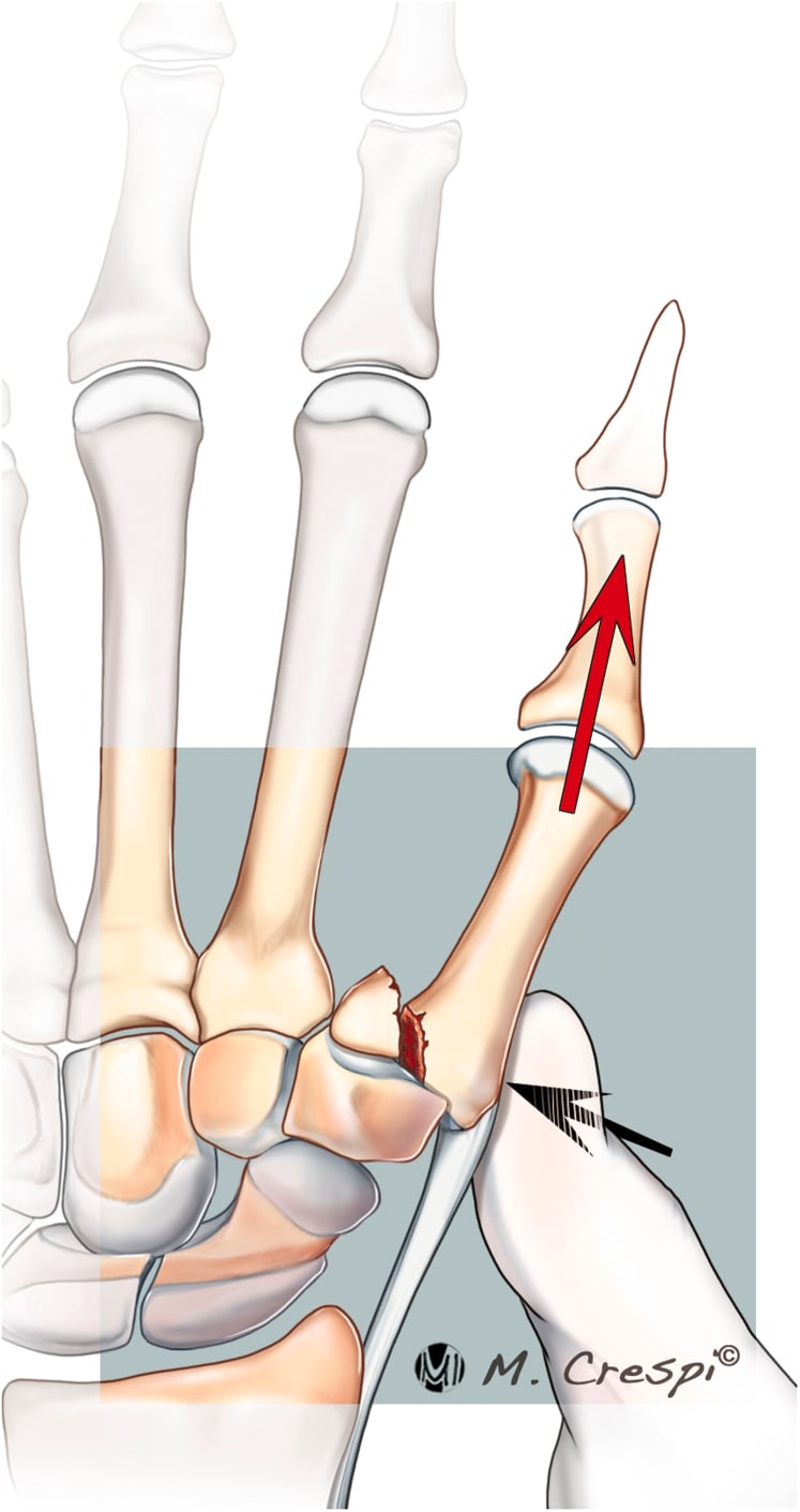 Preoperative Bett's view radiograph of Bennett fracture-subluxation of the 1st metacarpal base