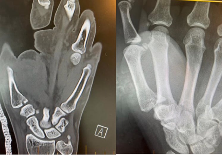 3D CT reconstruction demonstrating Bennett fracture fragment displacement
