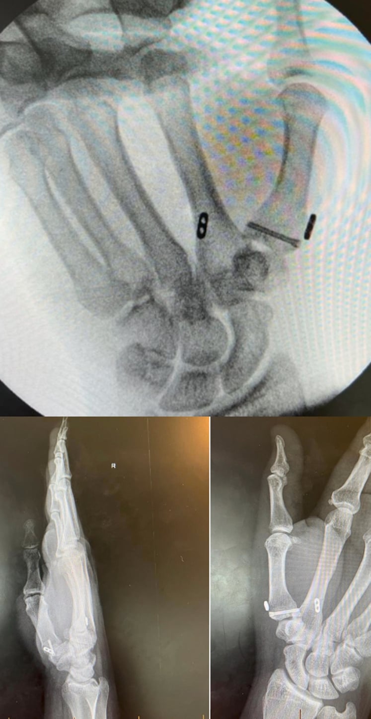 Postoperative Bett's view radiograph demonstrating 1st CMC joint reduction and screw fixation