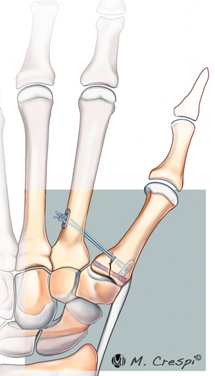 Intraoperative fluoroscopy demonstrating closed reduction and screw fixation of Bennett fracture
