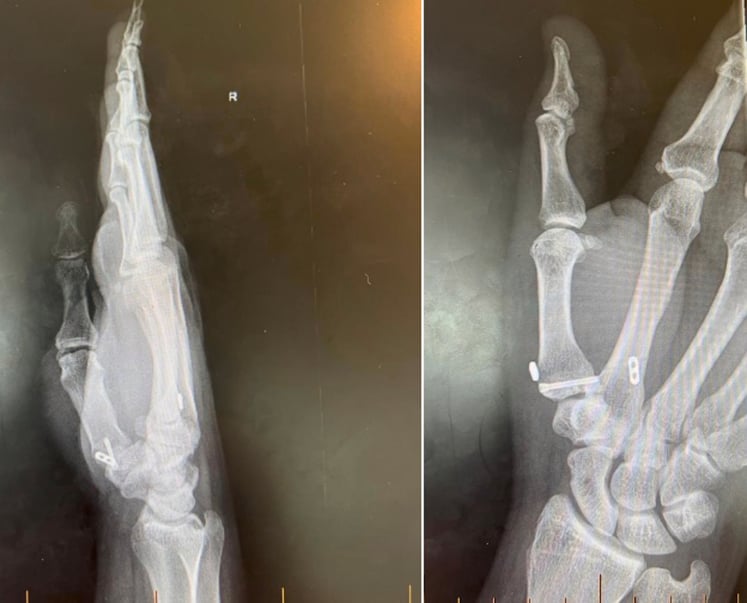 Follow-up Bett's view radiograph demonstrating 1st CMC joint space preservation and fracture union