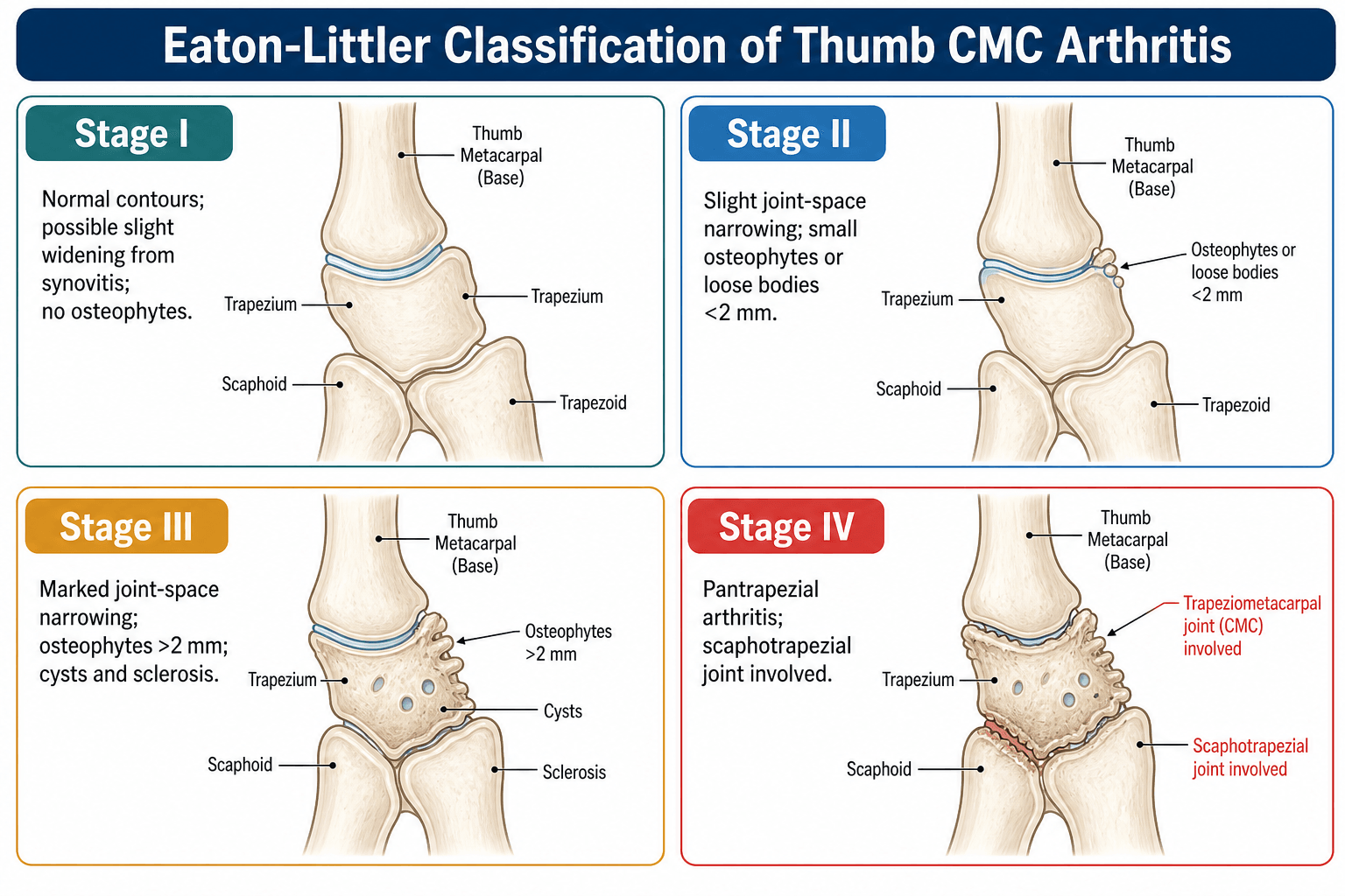 Eaton-Littler classification of thumb CMC arthritis