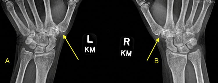 Radiographs of both hands showing carpometacarpal joint space narrowing, osteophytes and subluxation with arrows