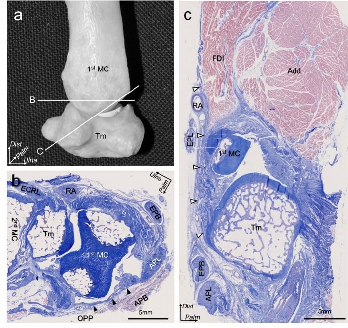 Histological axial sections through the trapeziometacarpal joint identifying dorsal and radial capsular thickness