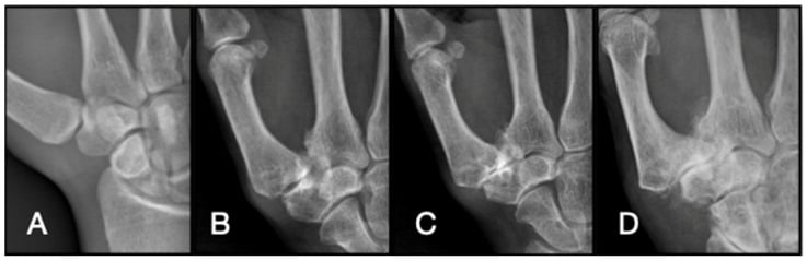Radiographs showing Eaton-Littler stage I to IV carpometacarpal arthrosis