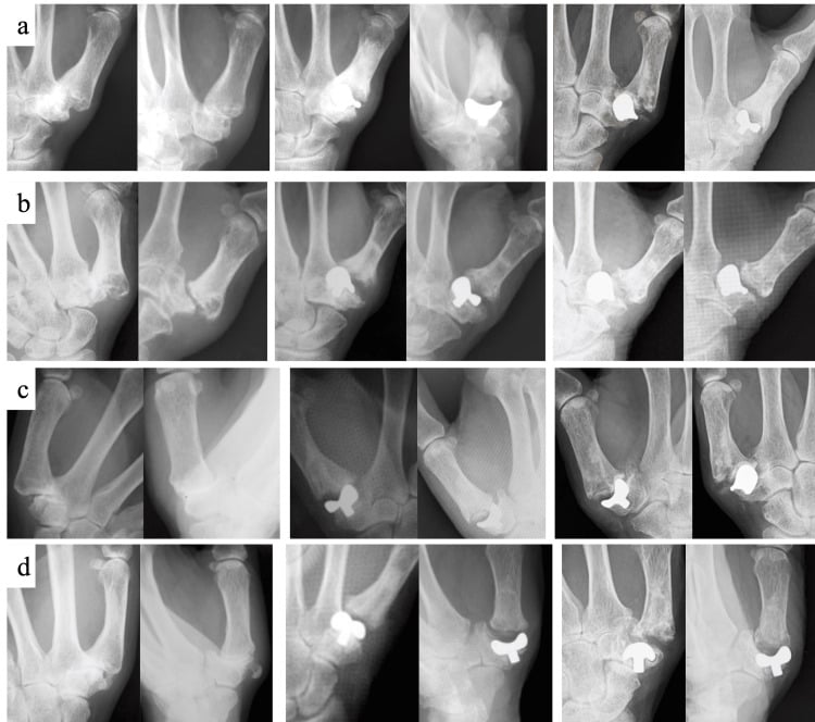 Preoperative, immediate postoperative and final follow-up radiographs of four thumb carpometacarpal implant arthroplasty cases