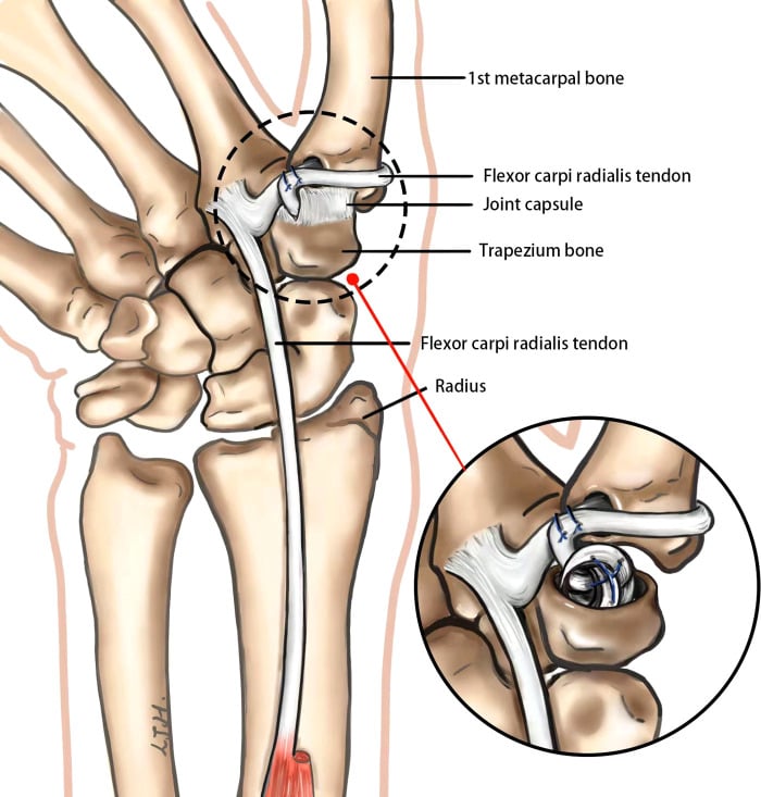 Diagram of ligament reconstruction with a tendon half passed through a transosseous tunnel in the first metacarpal base and sutured to itself