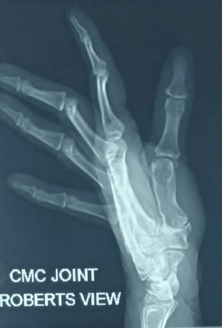 Robert view radiograph of the thumb carpometacarpal joint