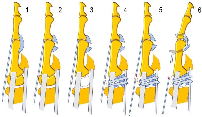 Diagram of sequential experimental stages from intact specimen through volar plate division, trapeziectomy, Weilby reconstruction and extensor pollicis brevis tenodesis
