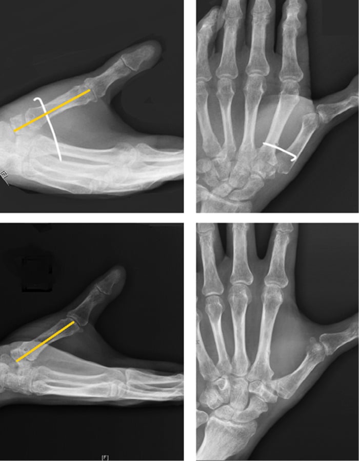 Fluoroscopic images at two and six months after trapeziectomy showing slight subsidence of the first metacarpal