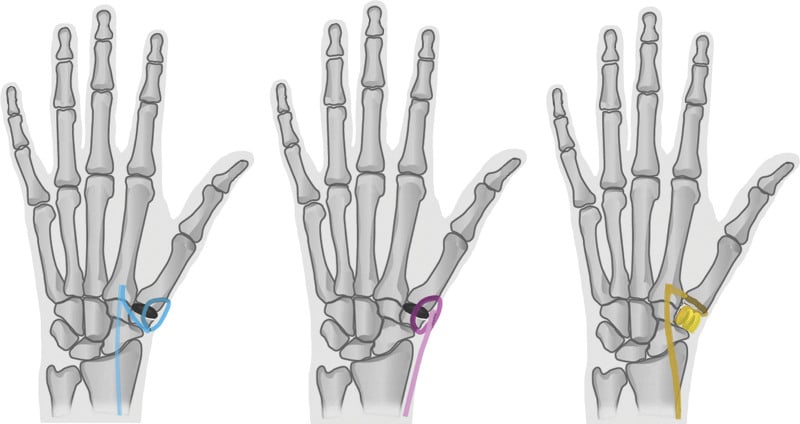 Illustrations of pyrocarbon disc interposition with flexor carpi radialis, with abductor pollicis longus, and ligament reconstruction with tendon interposition using flexor carpi radialis