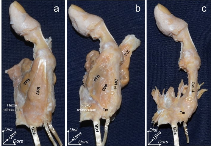 Macroscopic dissection of the radial aspect of the trapeziometacarpal joint showing abductor pollicis brevis, opponens pollicis, flexor pollicis brevis and the joint capsule
