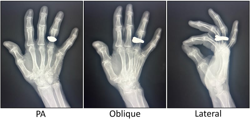 Posteroanterior, oblique and lateral radiographs of the hand demonstrating moderate thumb carpometacarpal osteoarthritis