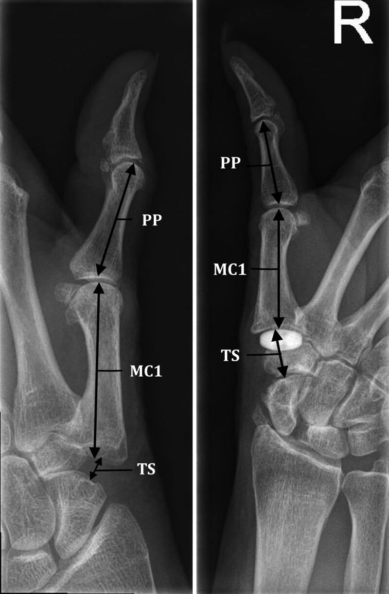 Postoperative radiographs demonstrating measurement of thumb length after ligament reconstruction with tendon interposition and after pyrocarbon disc interposition
