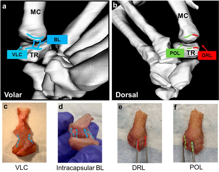 Volar and dorsal schematics of the trapeziometacarpal joint with ligament origins and insertions beside cadaveric dissection and intra-articular views