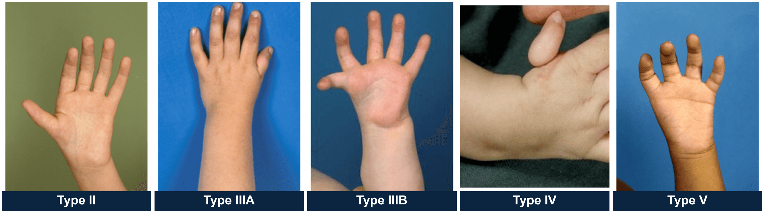 Clinical photograph series of thumb hypoplasia Blauth types II, IIIA, IIIB, IV and V.