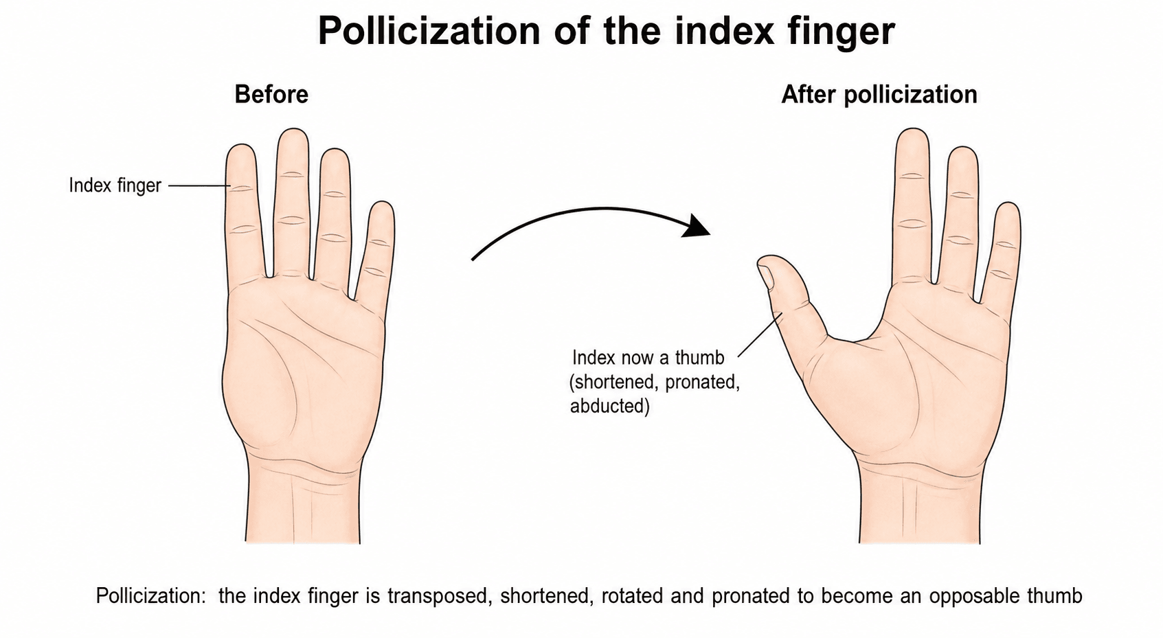 Two-panel diagram: a thumbless hand before pollicization, and after, with the index finger transposed into a shortened, abducted thumb position