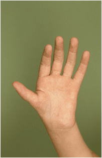 Palmar photograph of a child's hand with a small hypoplastic thumb (type II thumb hypoplasia)