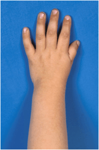 Dorsal photograph of a child's hand with a severely hypoplastic thumb