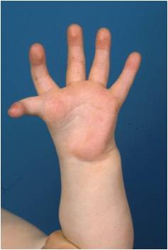 Palmar photograph of a child's hand with a severely deficient, vestigial-appearing thumb