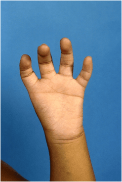 Palmar photograph of a child's hand with complete absence of the thumb (type V aplasia), showing four digits