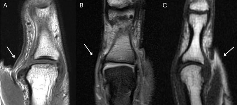 Coronal T2 MRI illustrating thumb UCL injury patterns and Stener lesion