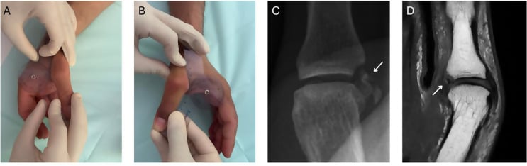 Preoperative valgus stress radiograph and coronal T2 MRI of thumb UCL injury