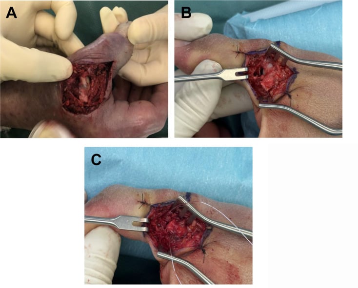 Intraoperative photograph demonstrating suture anchor reattachment of thumb UCL