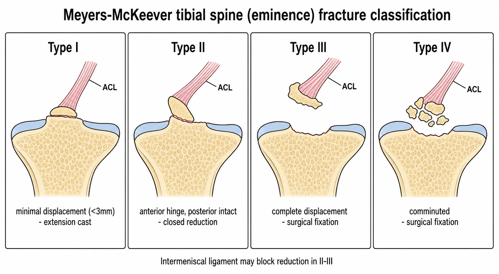Four-panel schematic of the Meyers-McKeever tibial spine fracture classification showing increasing displacement of the ACL-bearing eminence fragment from type I to type IV