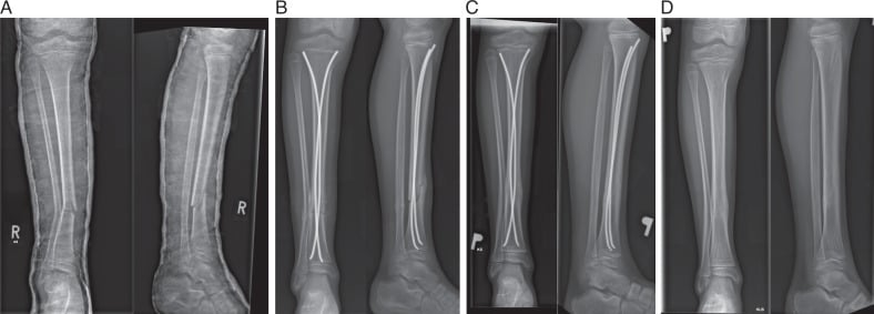 Serial AP and lateral radiographs showing paediatric tibial shaft fracture treatment with elastic stable intramedullary nails