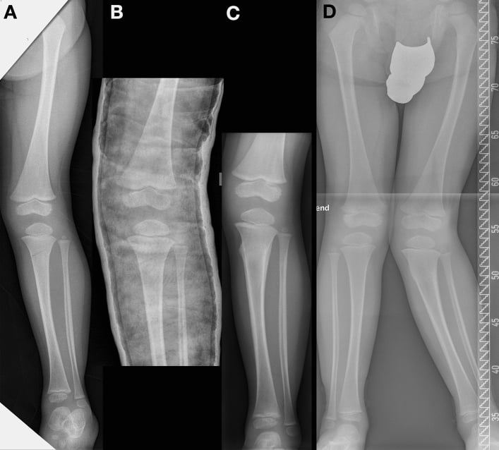 Serial radiographs showing progression from a paediatric proximal tibial greenstick fracture to post-traumatic valgus