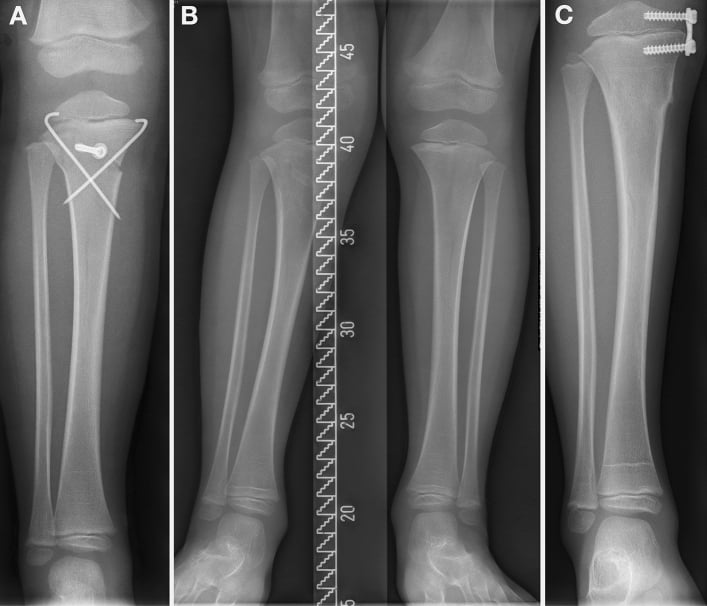 Serial radiographs of a paediatric proximal tibial greenstick fracture treated with reduction, K-wires and a screw