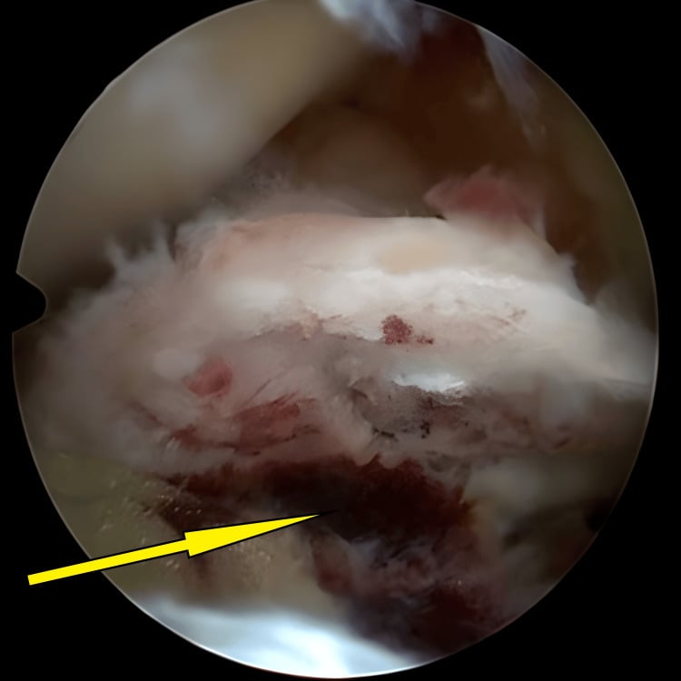 Arthroscopic view of a prepared tibial eminence fracture bed after haematoma clearance
