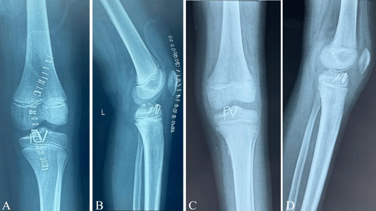 Immediate postoperative and three-month AP and lateral radiographs after paediatric tibial spine staple fixation