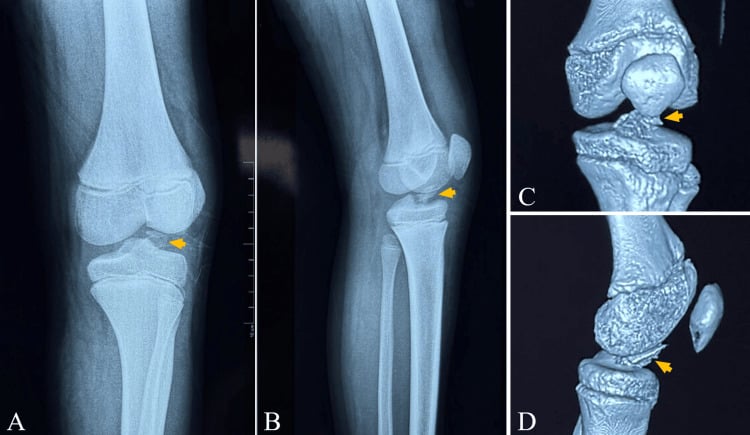 AP and lateral knee radiographs with three-dimensional CT showing a displaced paediatric tibial spine fracture