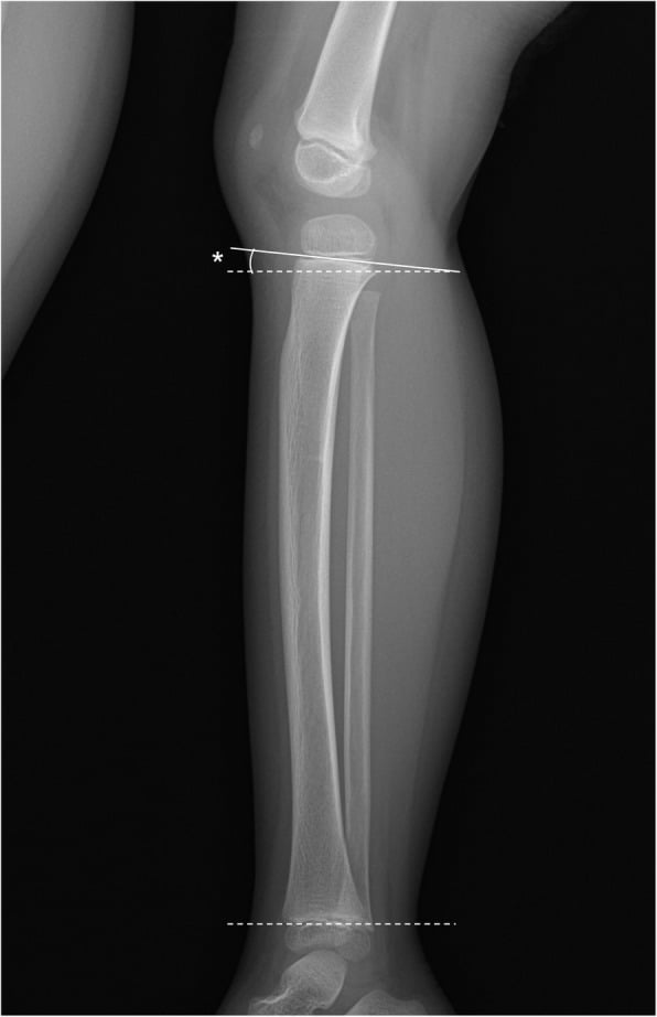 Lateral paediatric tibial radiograph showing construction of the anterior tilt angle