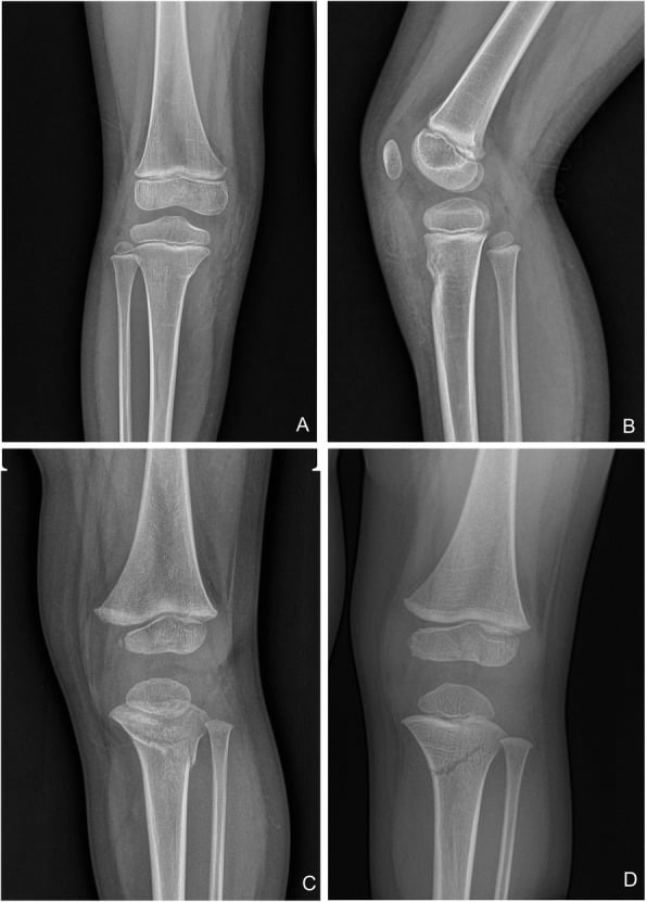 Four paediatric knee radiograph patterns of proximal tibial hyperextension injury